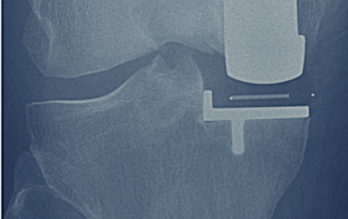 Photo of Knee Joint